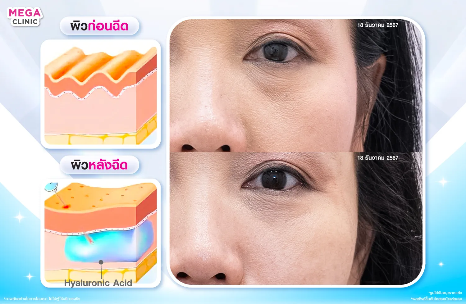 ก่อน และหลังฉีดฟิลเลอร์หน้าแก้ม