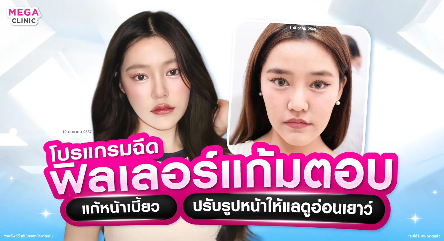 ฟิลเลอร์แก้มตอบ