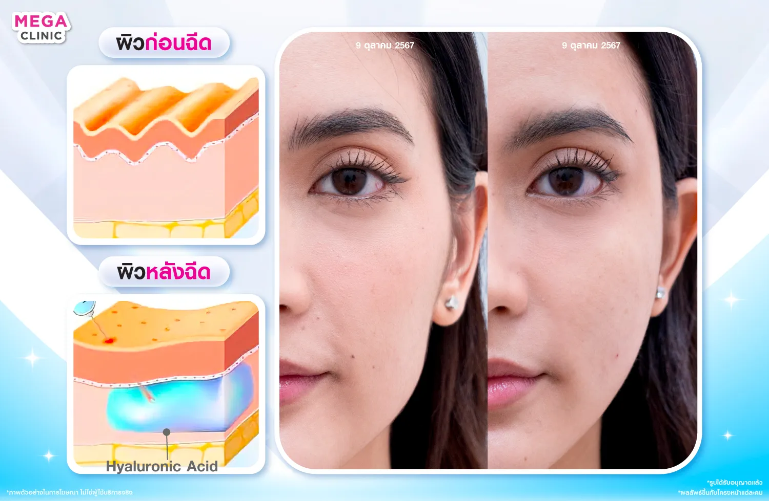 ฟิลเลอร์ คืออะไร