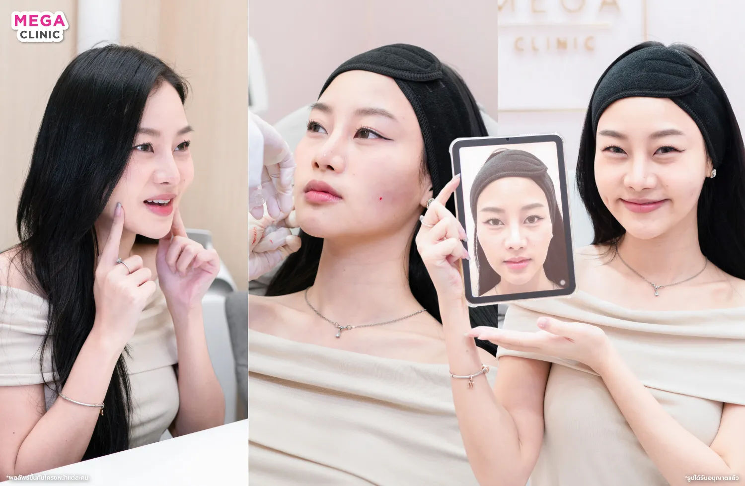 ฉีดฟิลเลอร์แก้ปัญหาแก้มตอบ