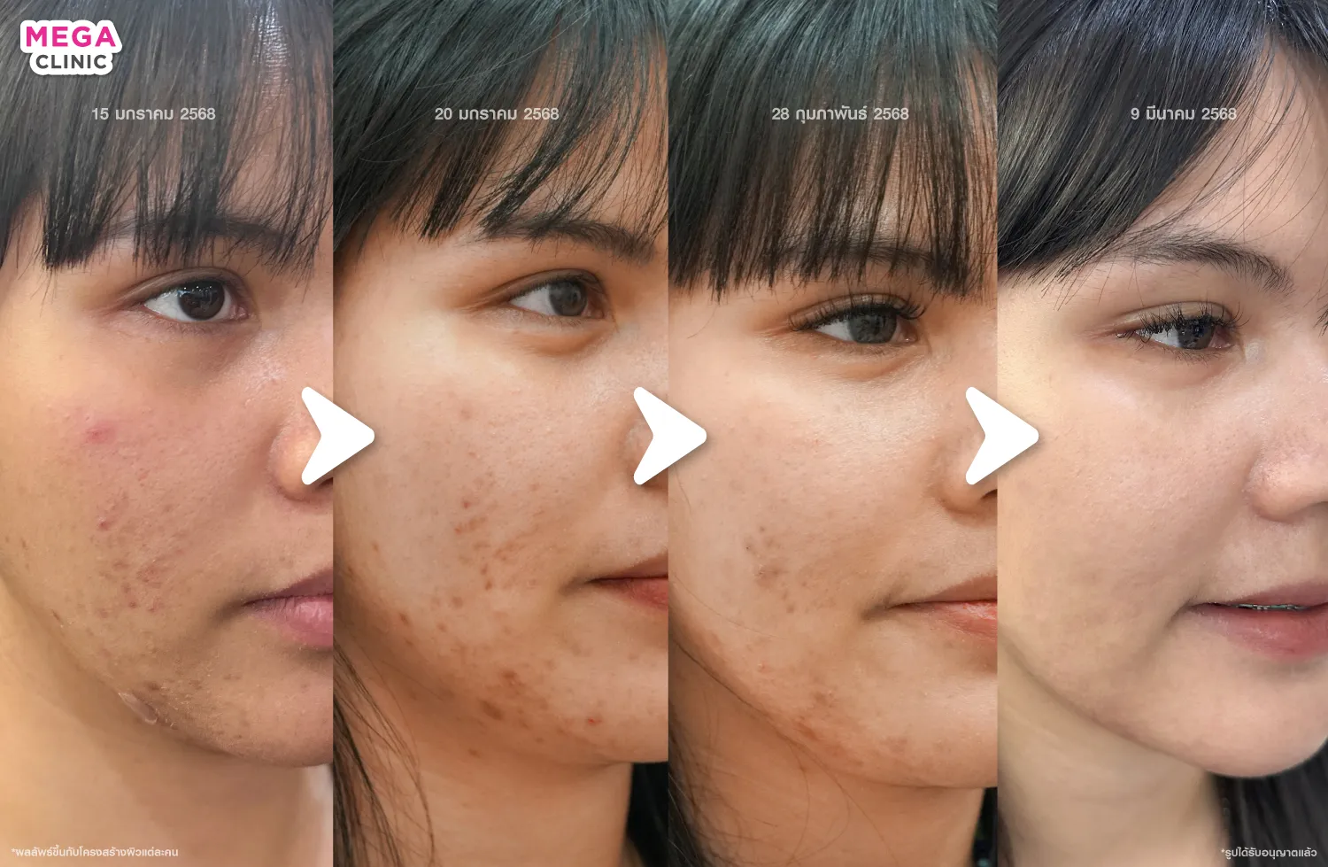 ออร่าไวท์ ควรทำต่อเนื่องกี่ครั้ง