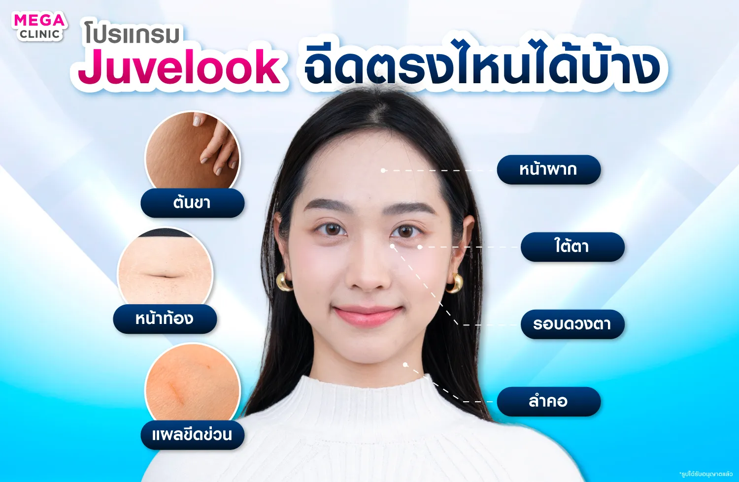 Juvelook ฉีดตรงไหน