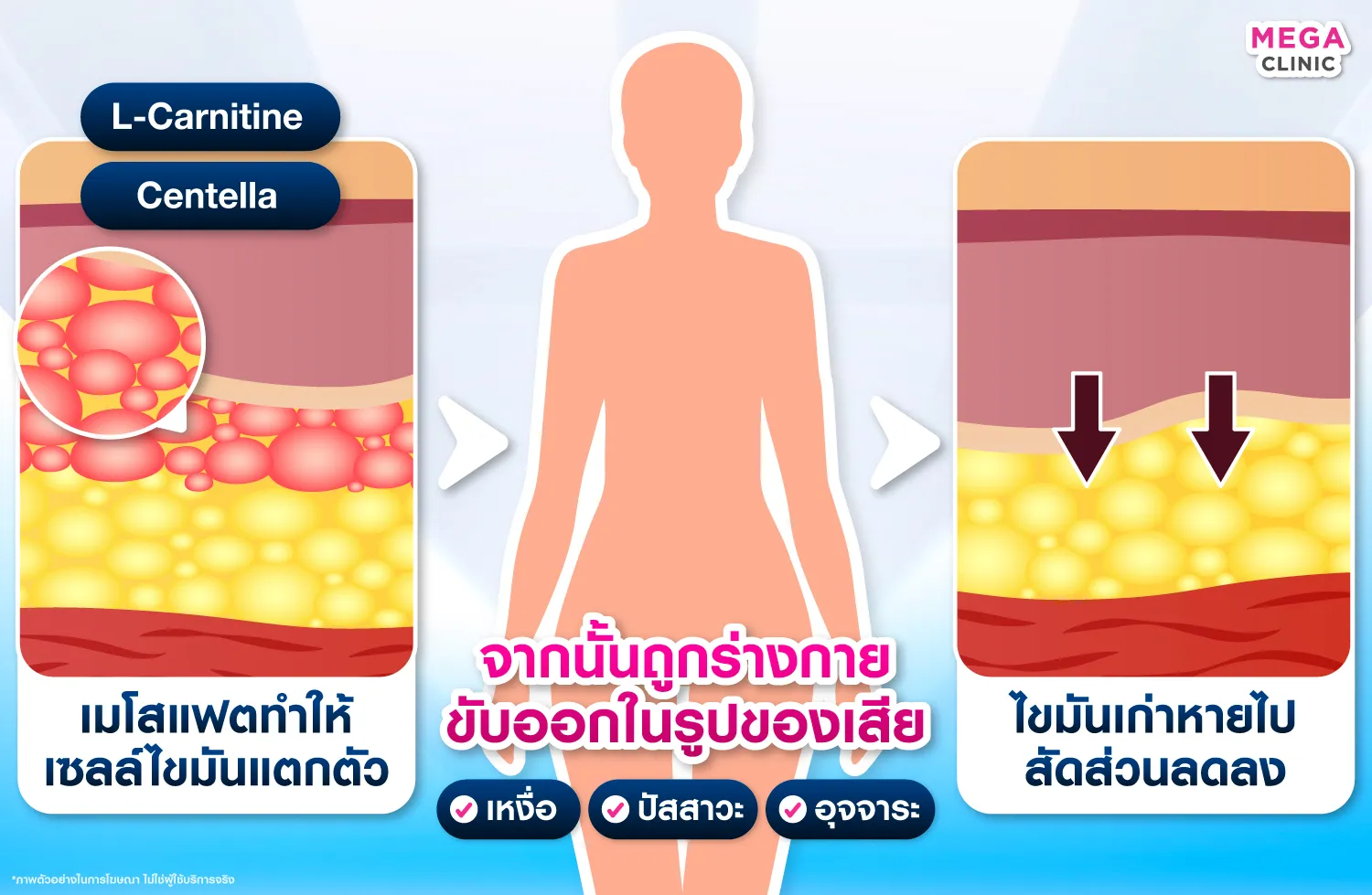 กระบวนการลดไขมัน เมื่อฉีดแฟต