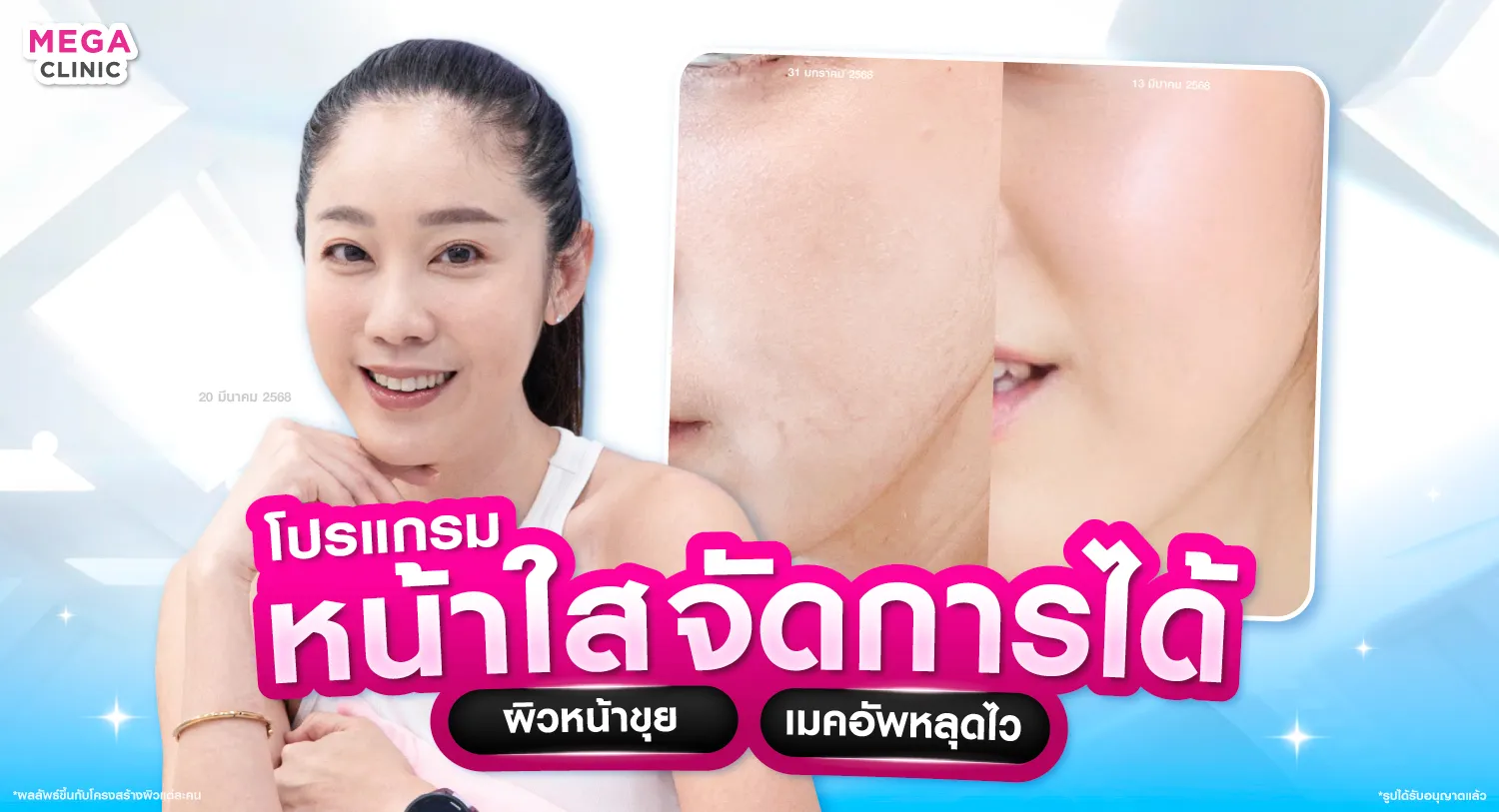 ฉีดหน้าใส ลดหน้าขุย แต่งหน้าติด