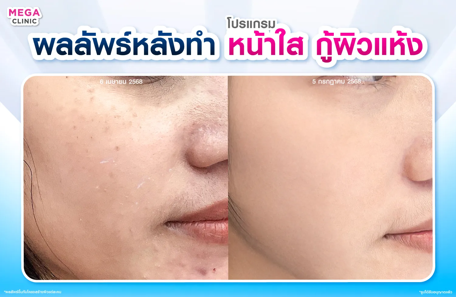 ฉีดหน้าใส แก้ปัญหาผิวแห้ง