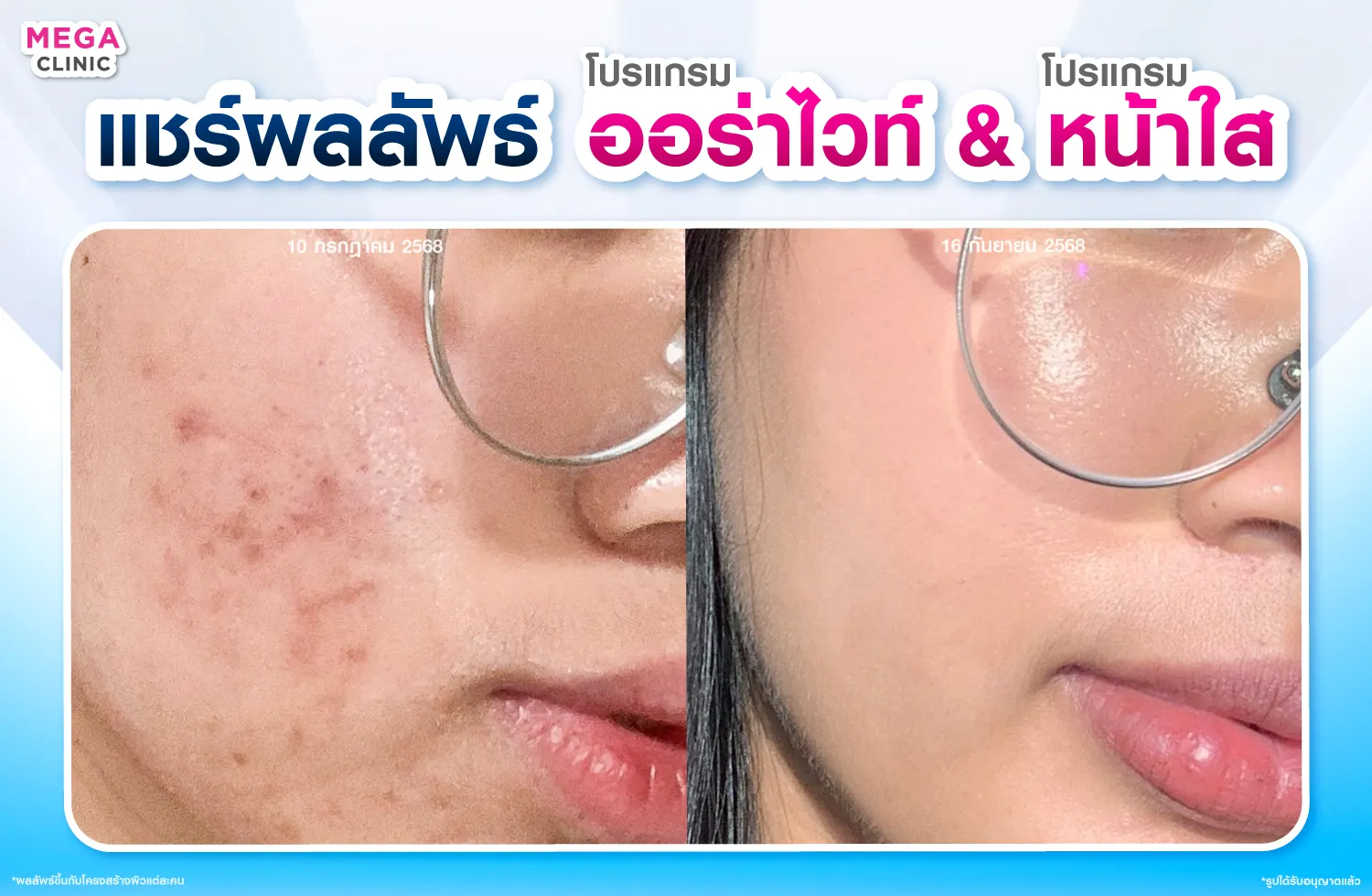 ฉีดออร่าไวท์ กับ ฉีดหน้าใส แก้ปัญหาผิวแห้ง ลดรอยสิว หน้าโทรม