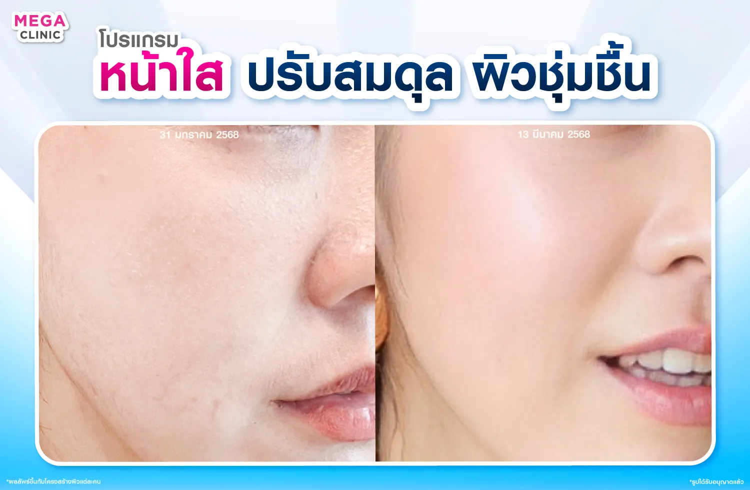 ฉีดหน้าใส ผิวชุ่มชื้น แก้ผิวแห้ง