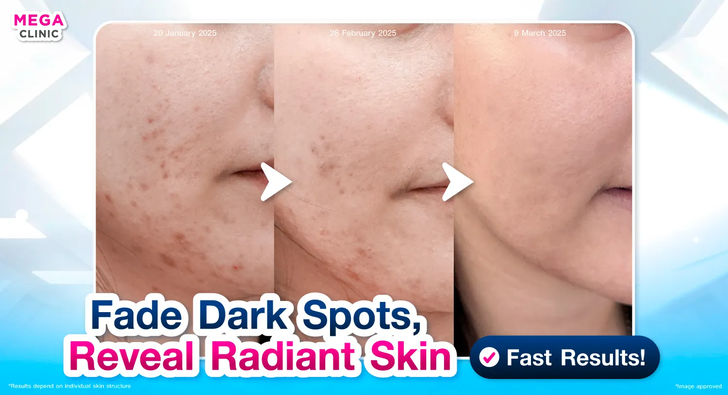 วิธีรักษารอยสิว