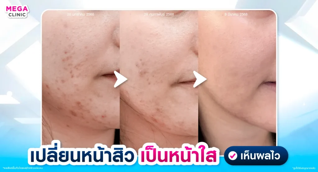 วิธีรักษารอยสิว