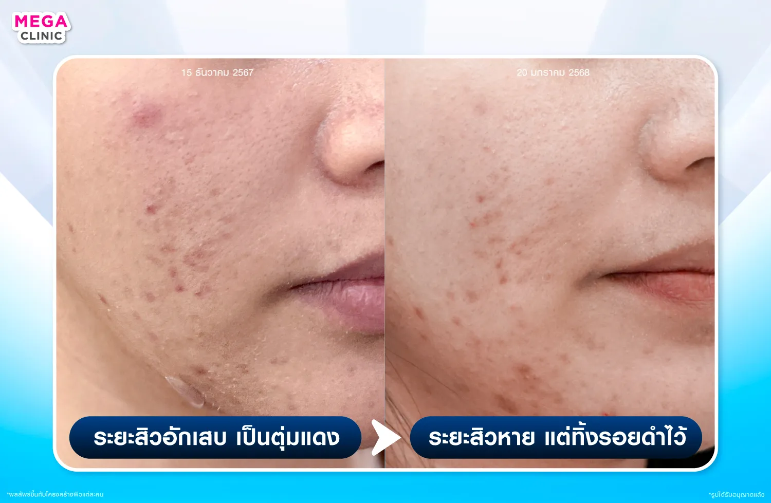 สิวอักเสบเป็นตุ่มแดง เมื่อหายแล้วทิ้งรอยดำจากสิวไว้