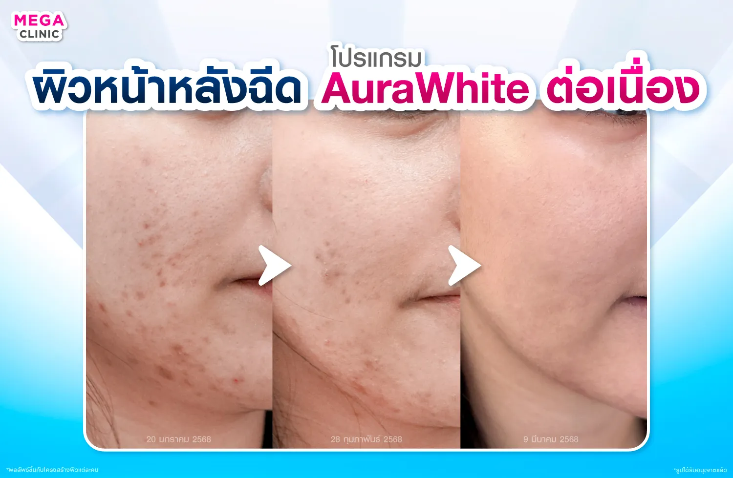 รีวิว ผิวหน้าหลังฉีด AuraWhite