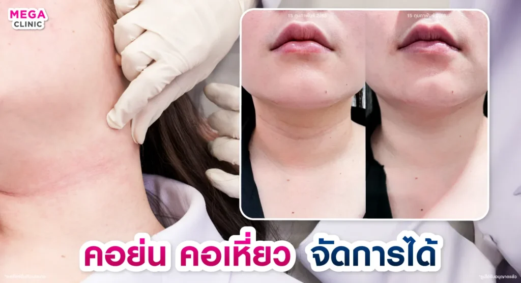 คอเหี่ยว คอเป็นเส้น แก้ยังไง