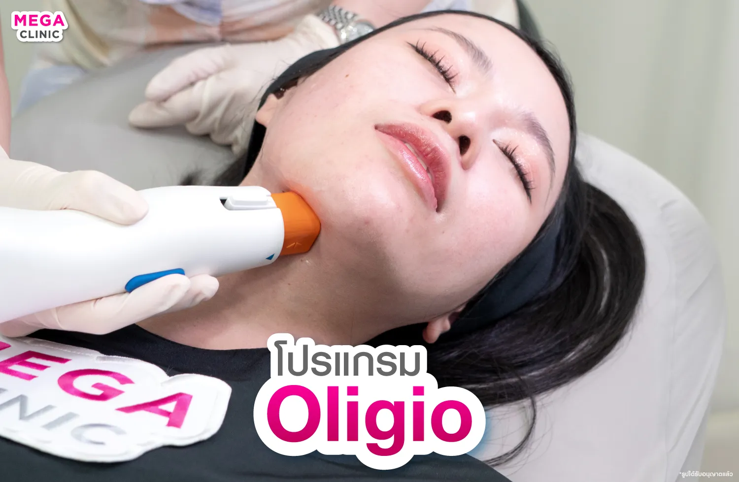 ทำ Oligio บริเวณคอ ลดเส้นริ้วที่คอ