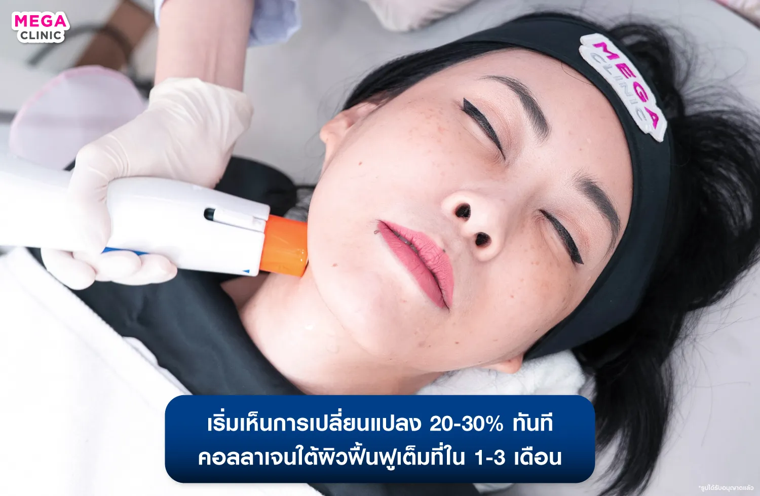 ทำ Oligio บริเวณคอ