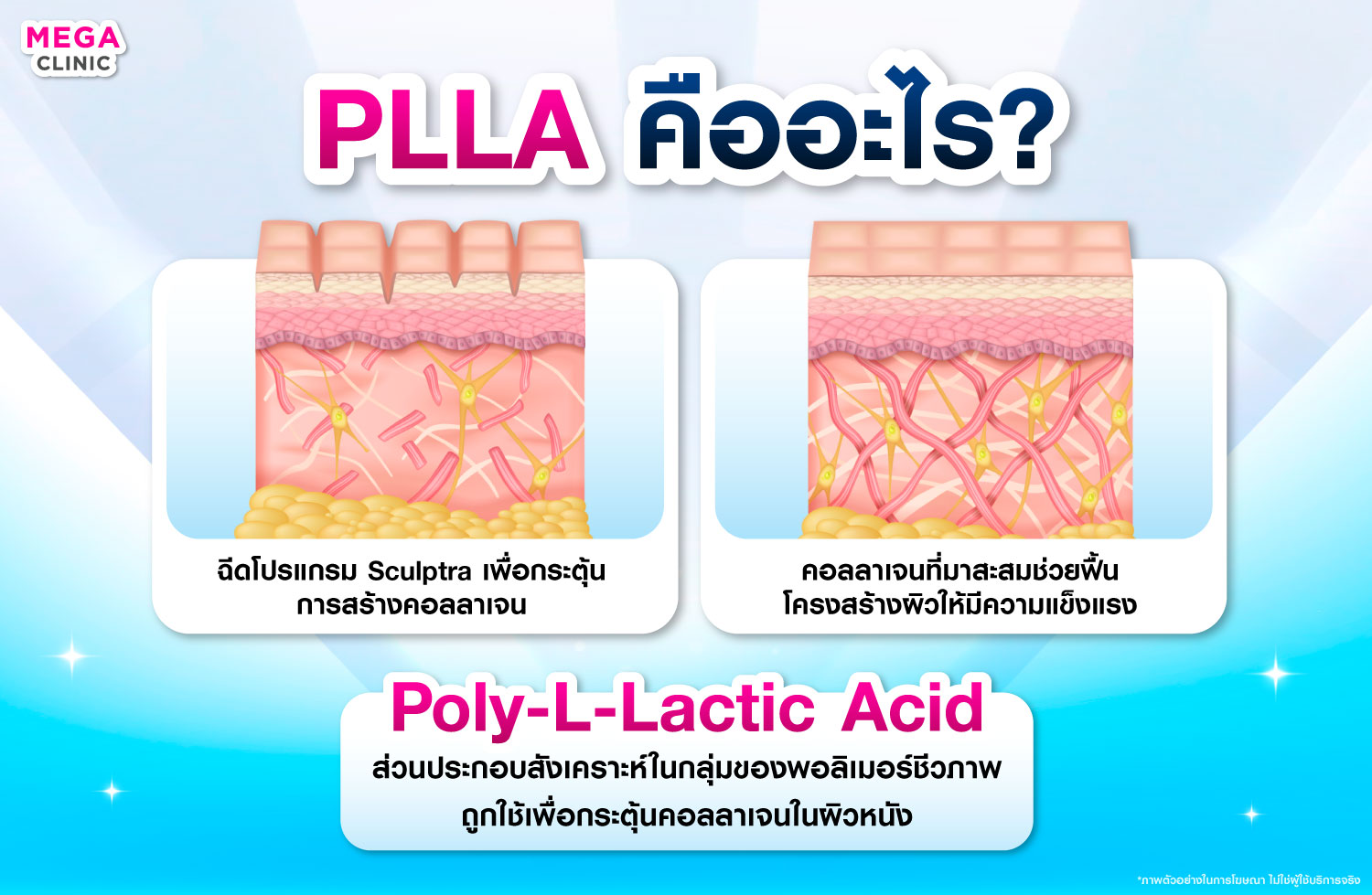 PLLA คืออะไร