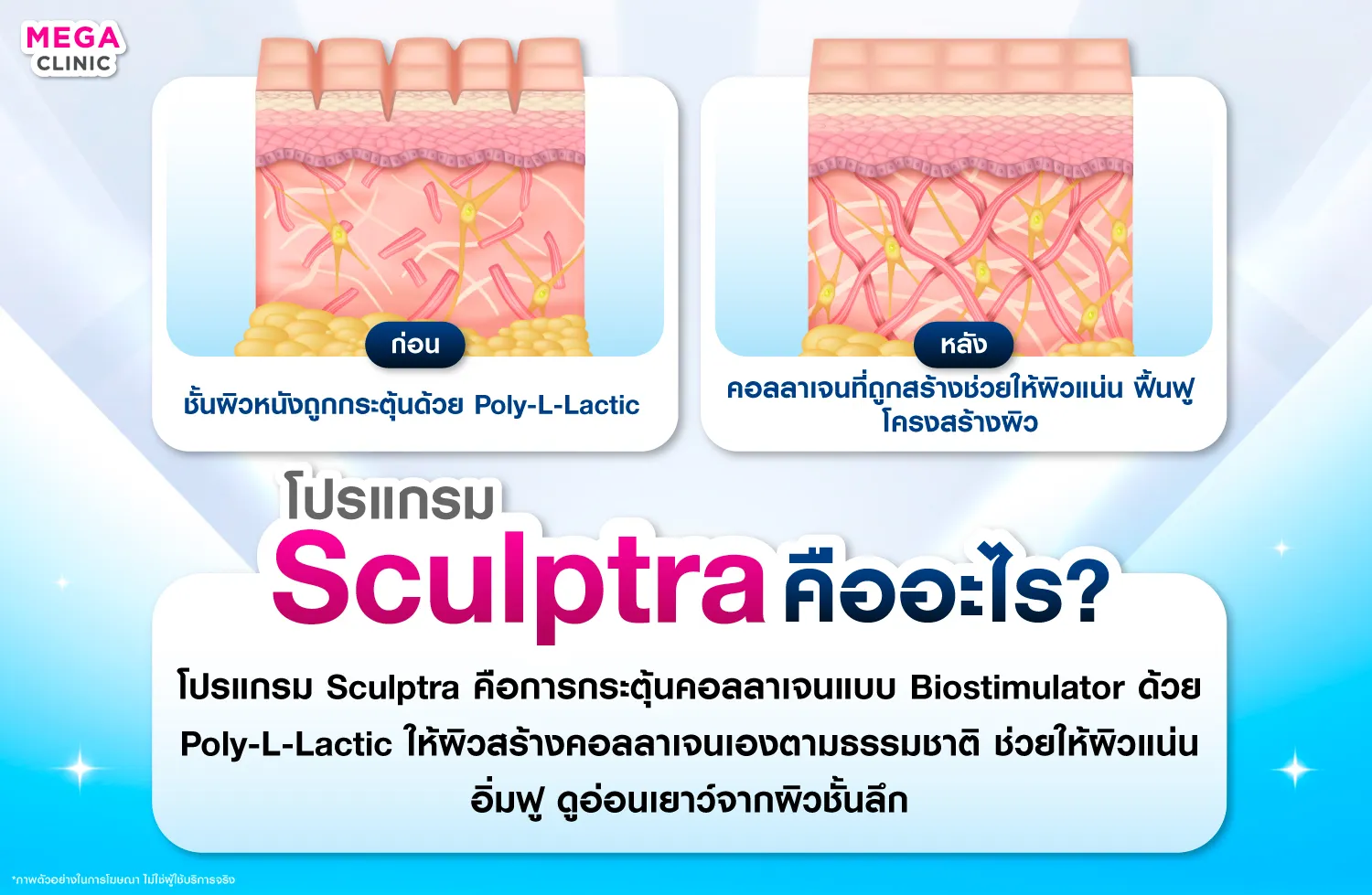 sculptra คืออะไร ช่วยอะไร