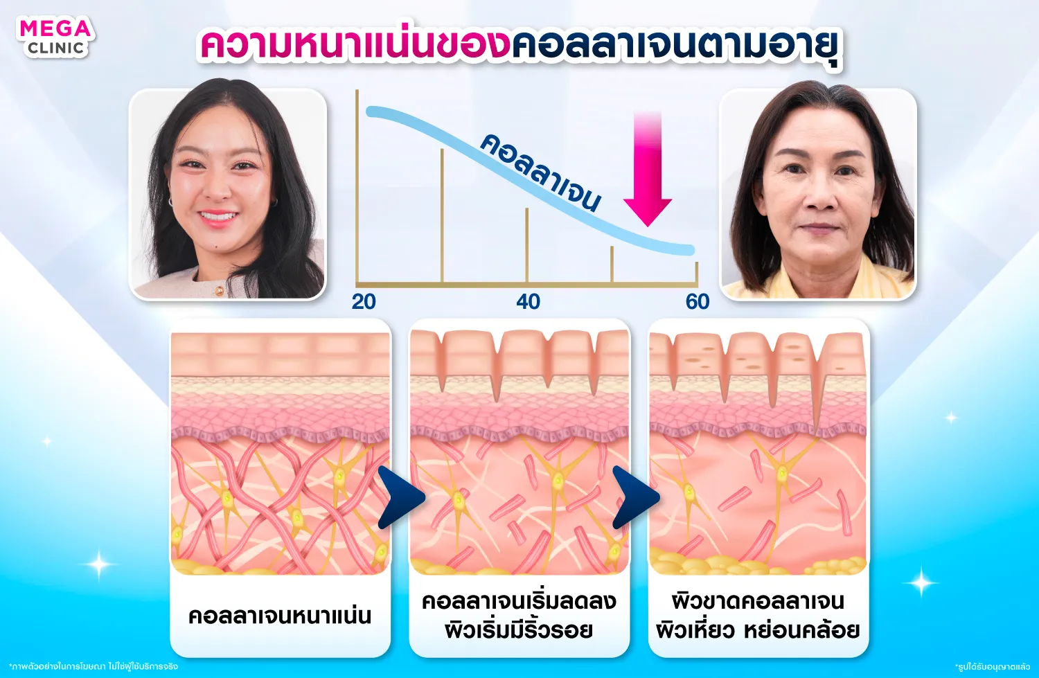 sculptra กระตุ้นสร้างคอลลาเจน