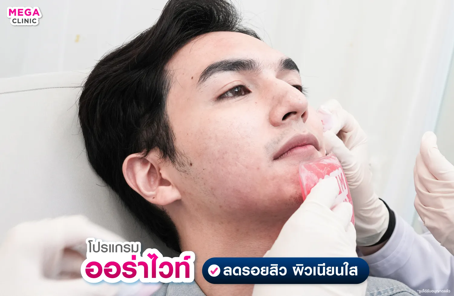 ฉีดออร่าไวท์ ลดรอยสิว รอยดำ