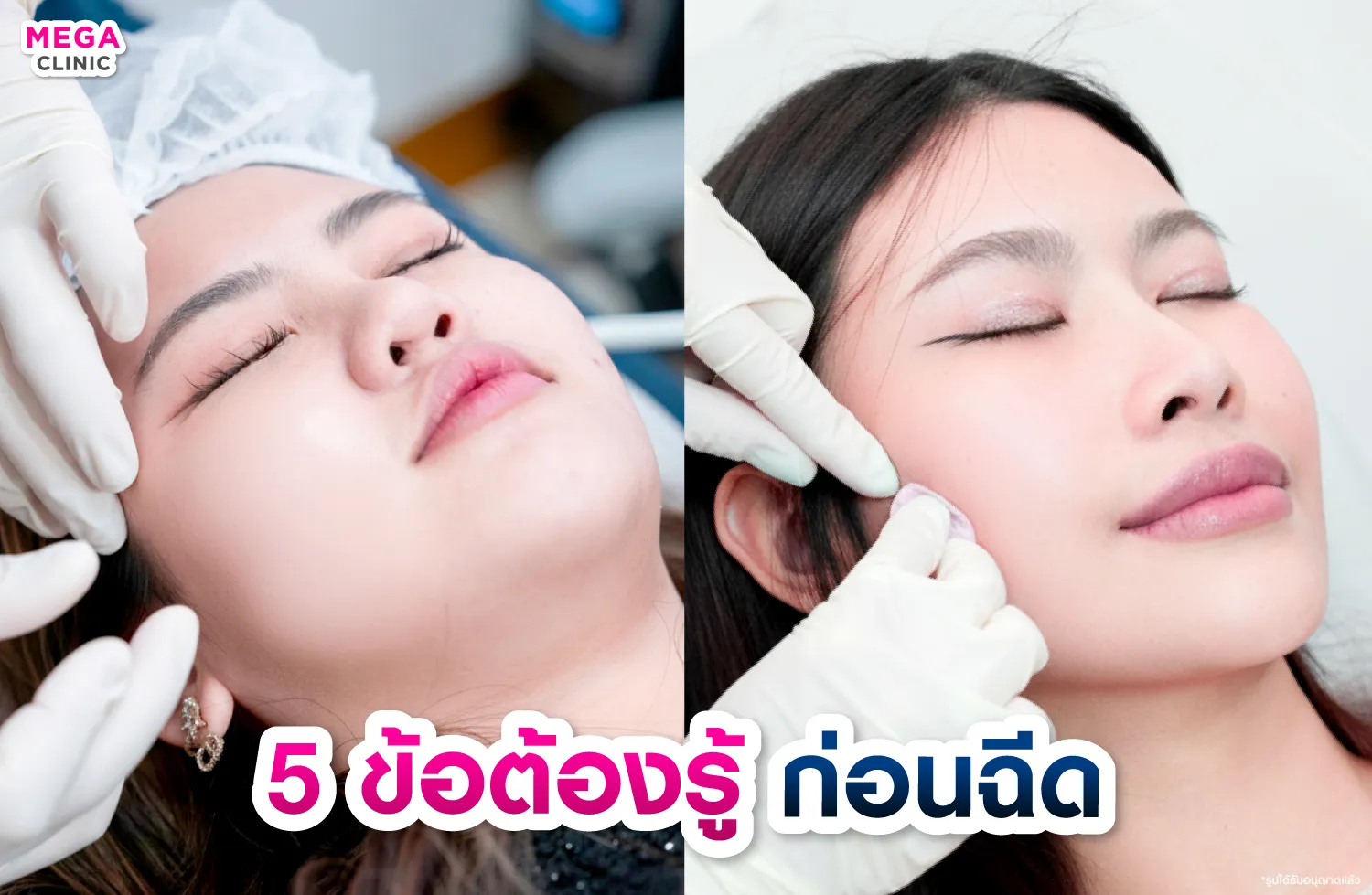 คำถามที่พบบ่อย เกี่ยวกับการฉีด Juvelook และ Rejuran