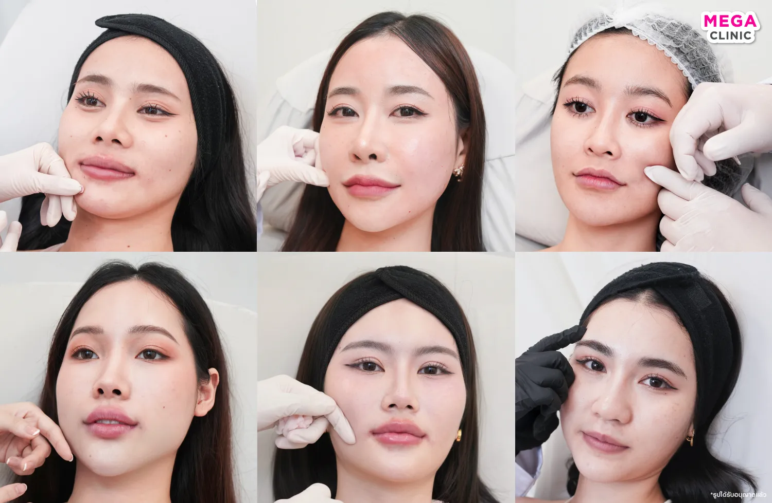 ฉีดฟิลเลอร์ที่ MEGA CLINIC ได้ทั้ง 5 สาขา