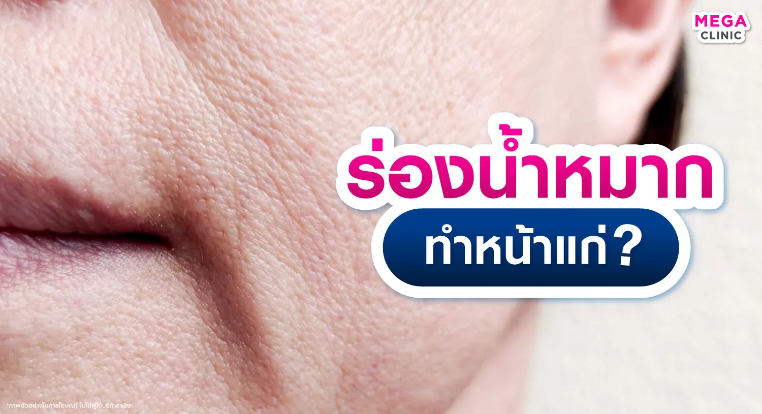 ร่องน้ำหมาก แก้ยังไง