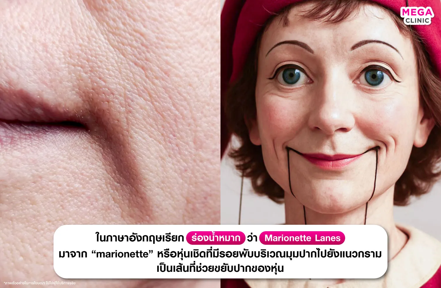 ร่องน้ำหมาก เป็นยังไง