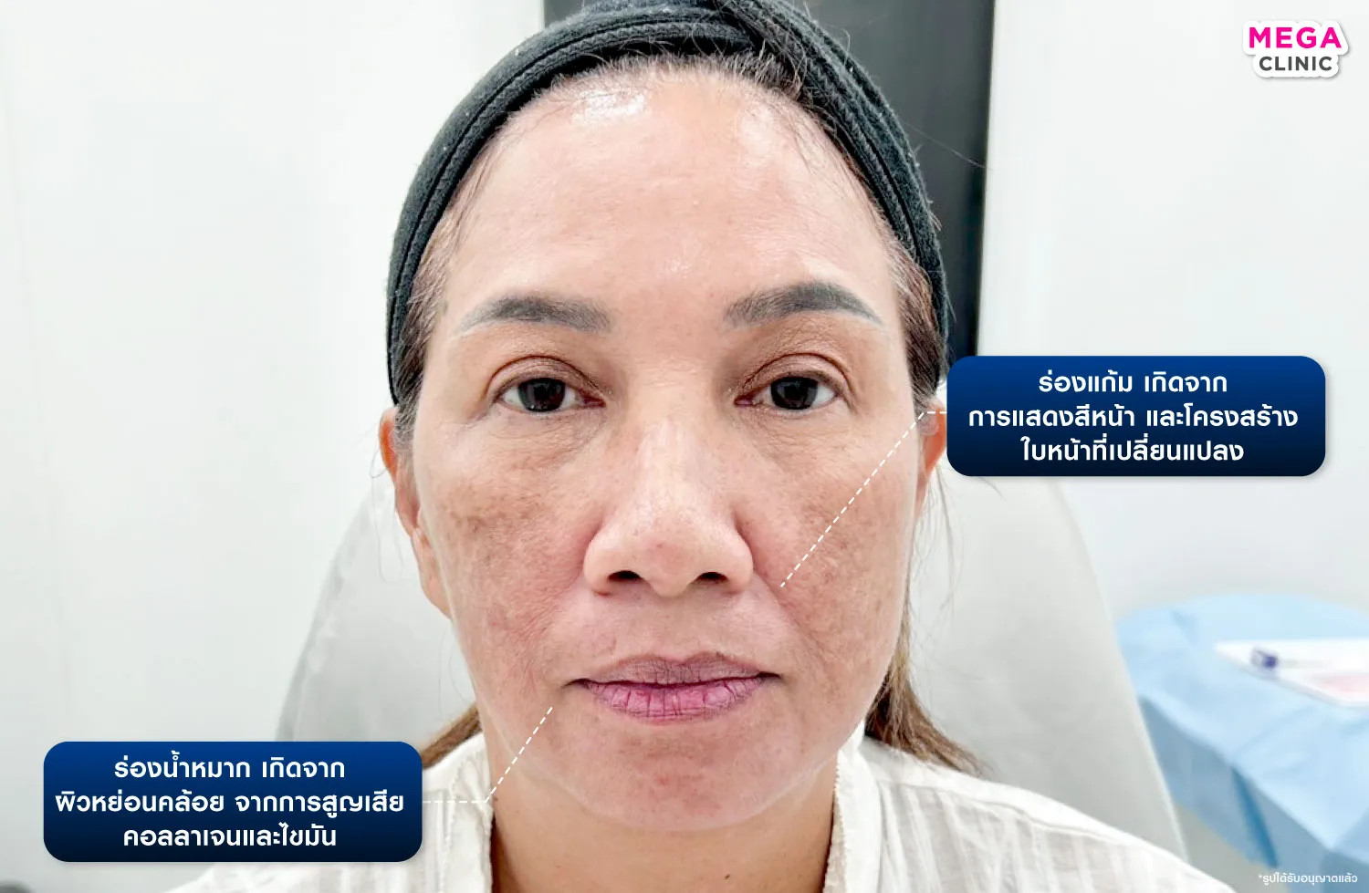 ร่องน้ำหมาก กับ ร่องแก้ม ต่างกันยังไง