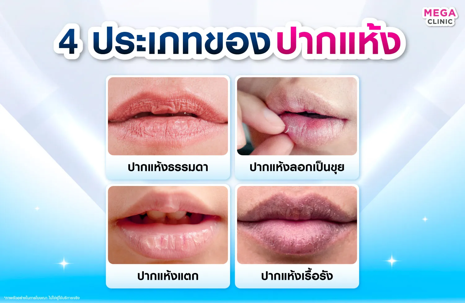 ปากแห้งมีกี่ประเภท