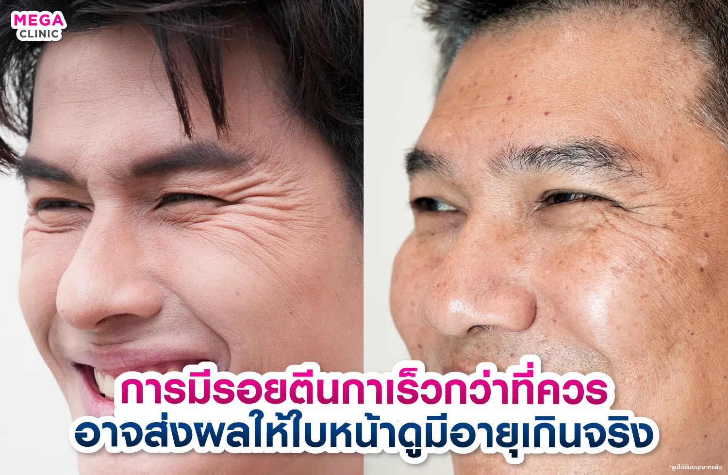 รอยตีนกา ทำให้หน้าดูแก่