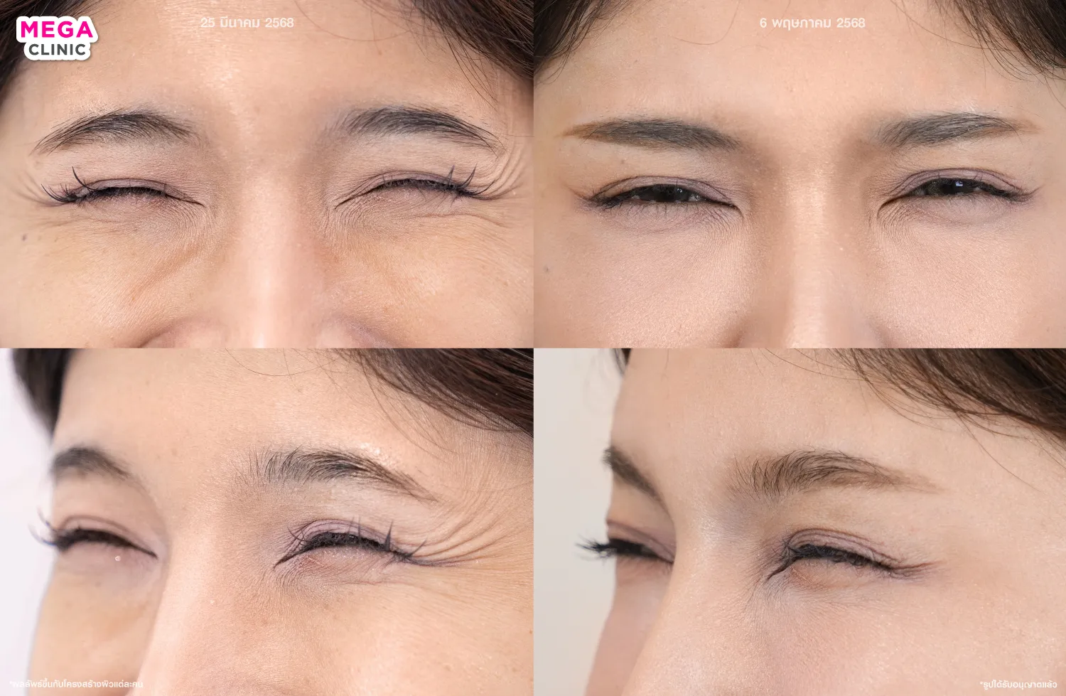 รีวิวหลังจากฉีดโบท็อกลดรอยตีนกา