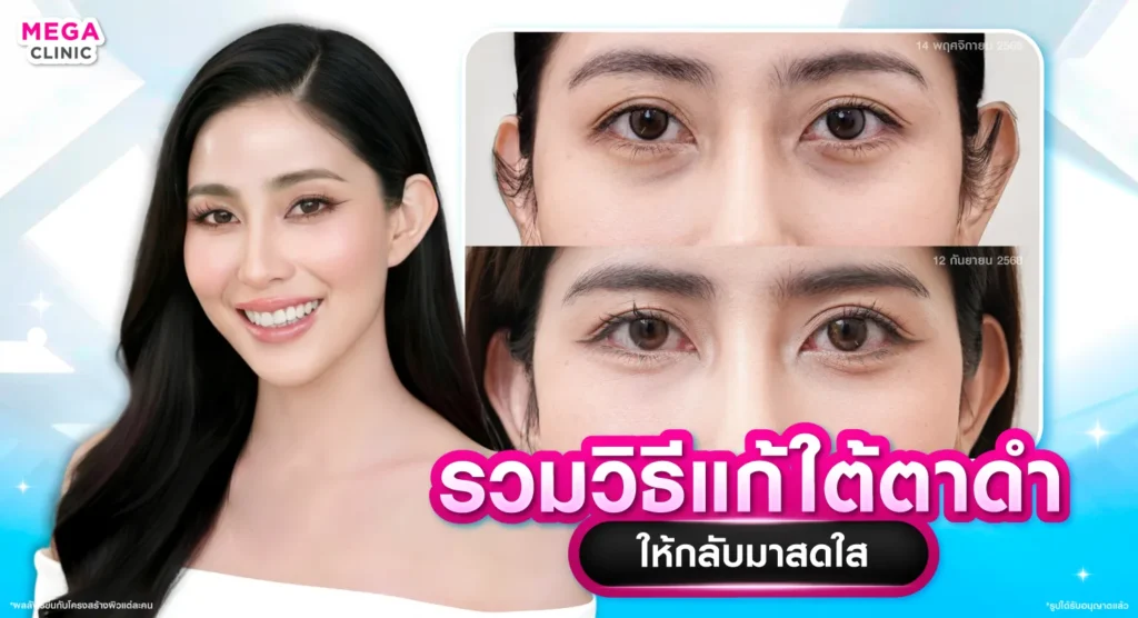 ใต้ตาดำ แก้ยังไง