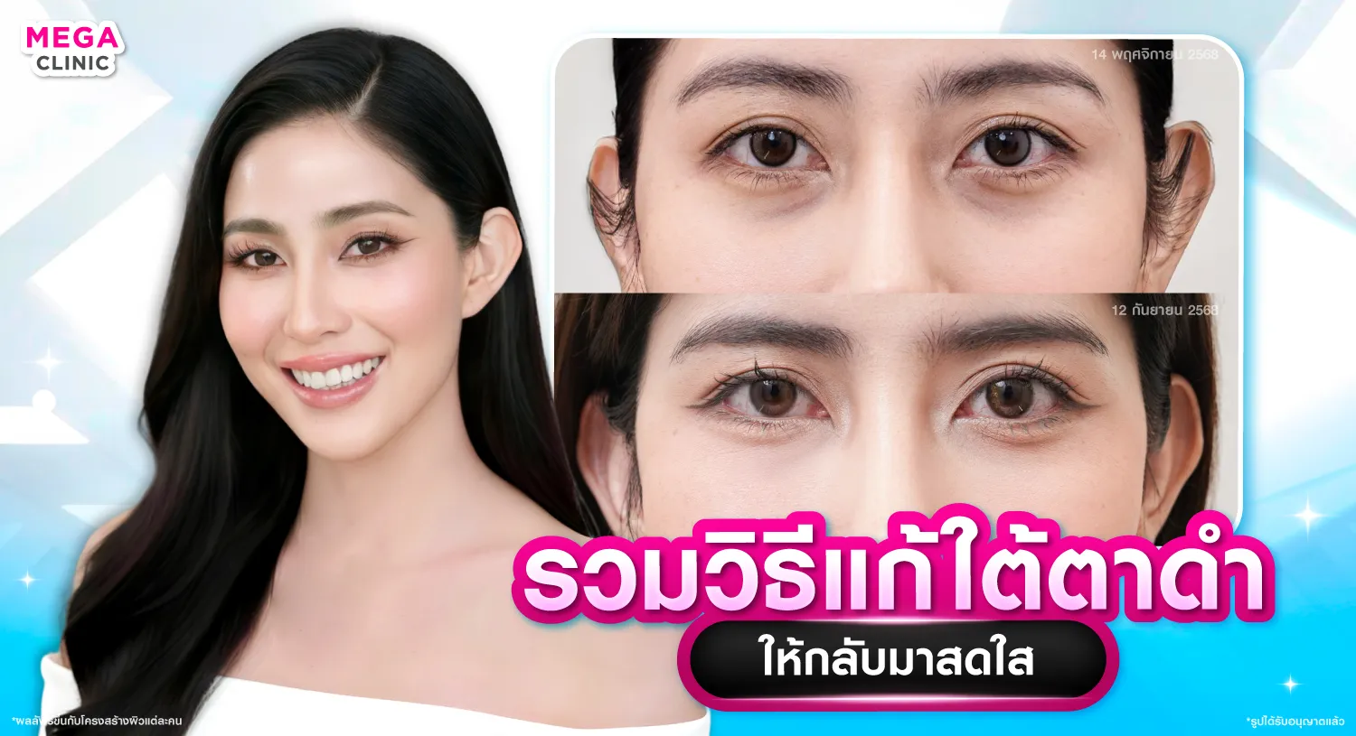 ใต้ตาดำ แก้ยังไง