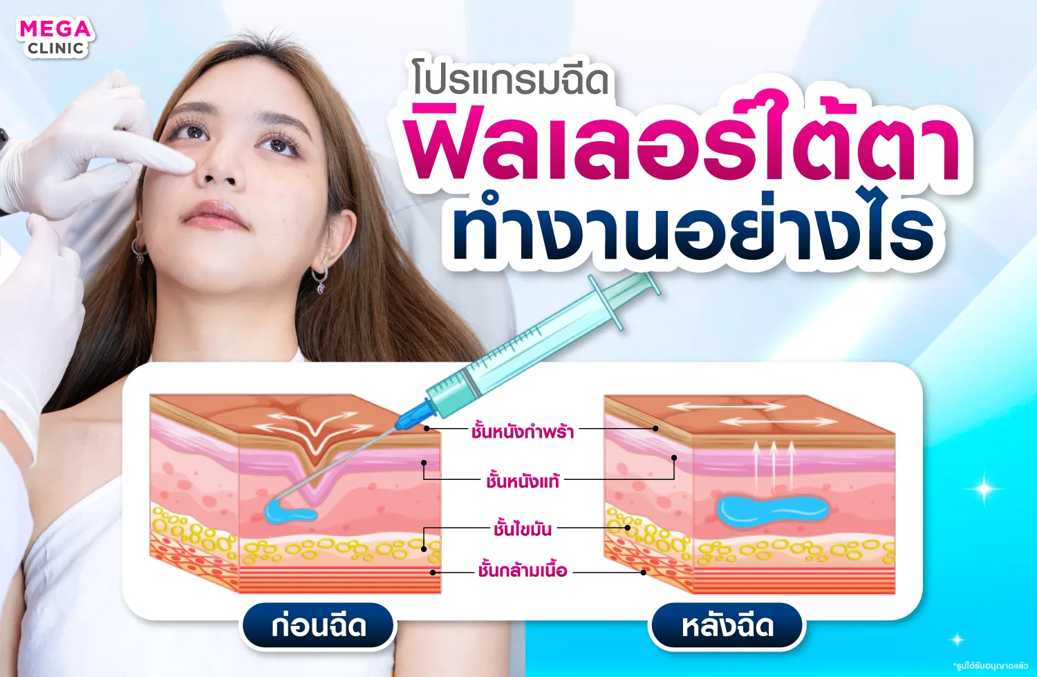 ฉีดฟิลเลอร์ใต้ตา เติมเต็มใต้ตา แก้ใต้ตาดำ