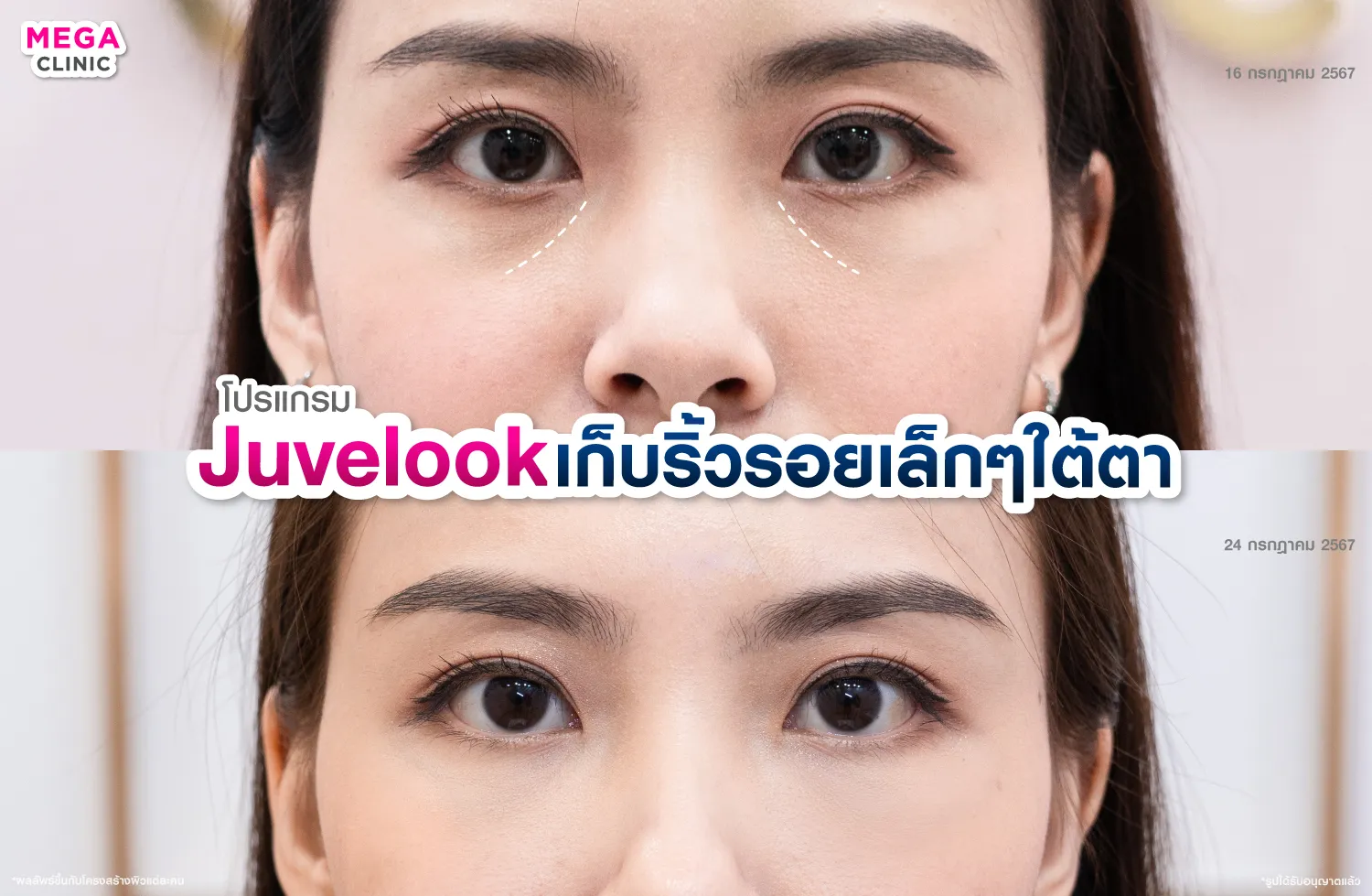 Juvelook ลดใต้ตาดำ เติมเต็มร่องลึก