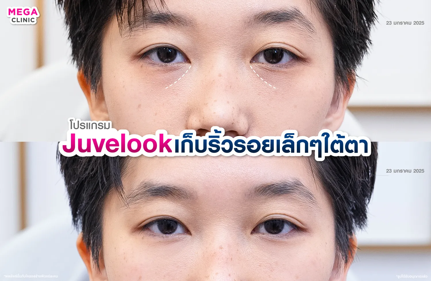 Juvelook ลดใต้ตาดำ เติมเต็มร่องลึก