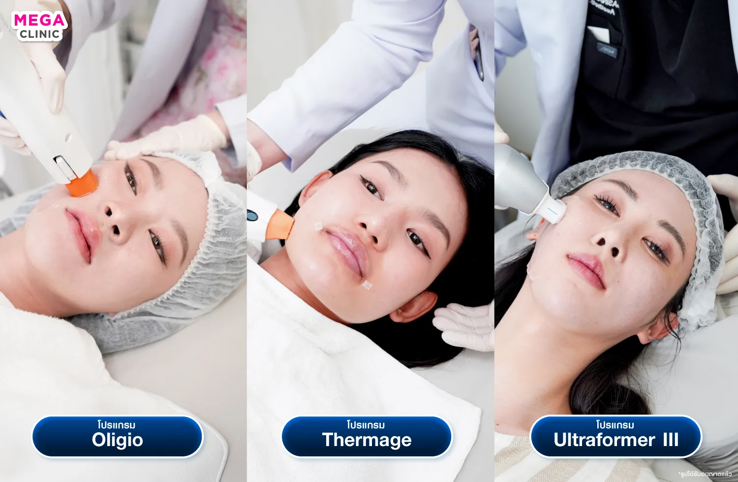 เปรียบเทียบ Oligio vs Thermage vs Ultraformer ต่างกันยังไง