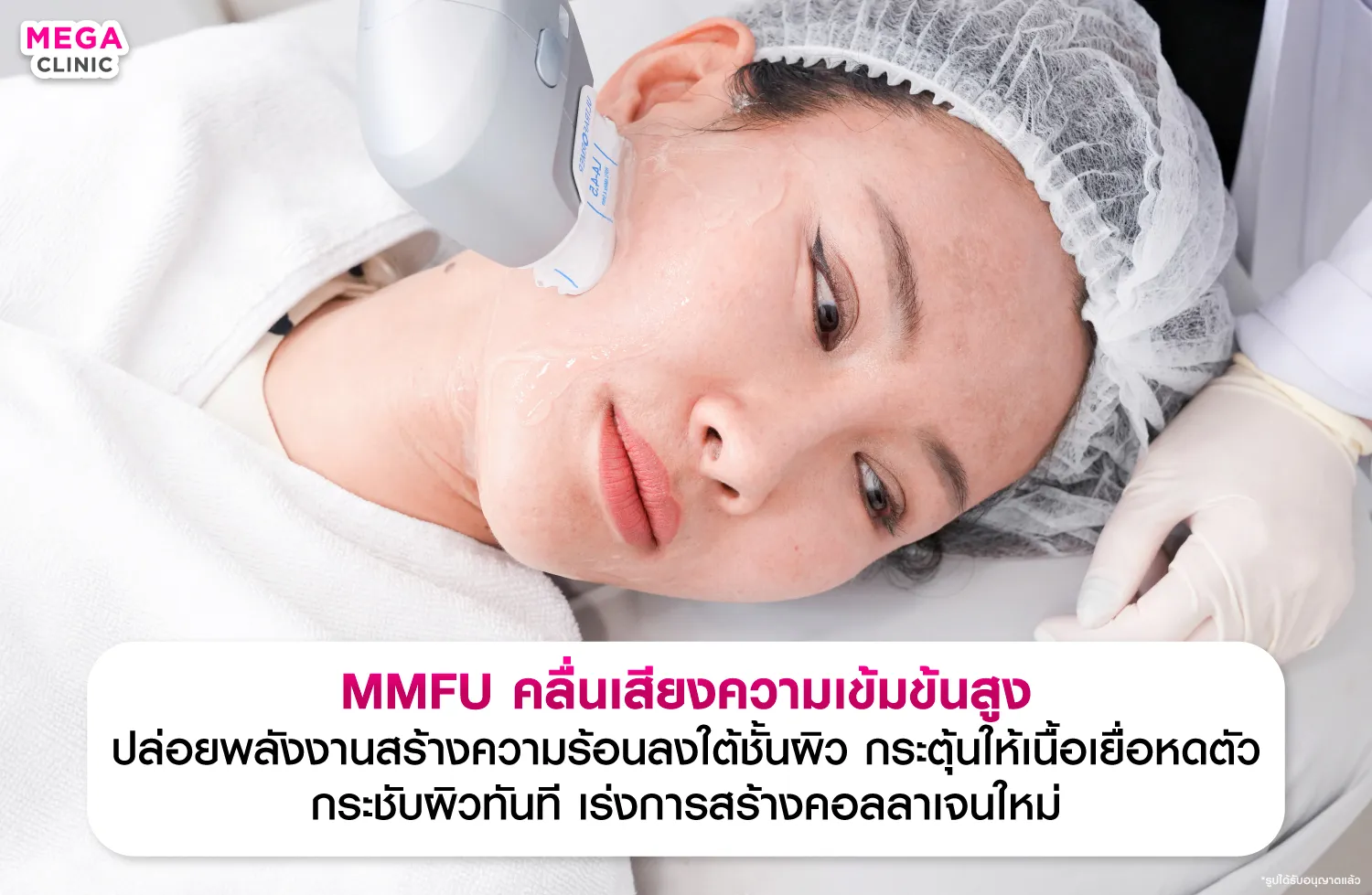 คลื่น MMFU คืออะไร