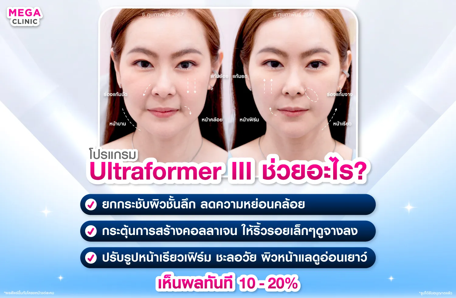 Ultraformer III ช่วยเรื่องอะไร