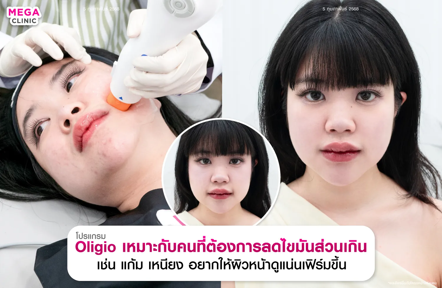 oligio เหมาะกับใคร