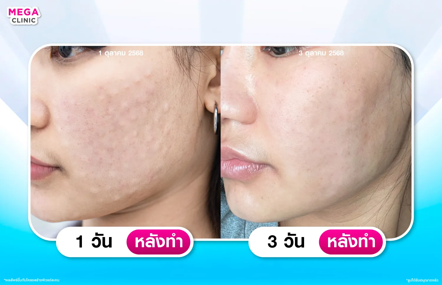 รีวิว Rejuran