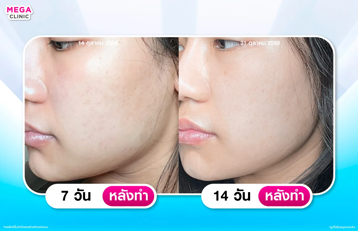 รีวิว Rejuran