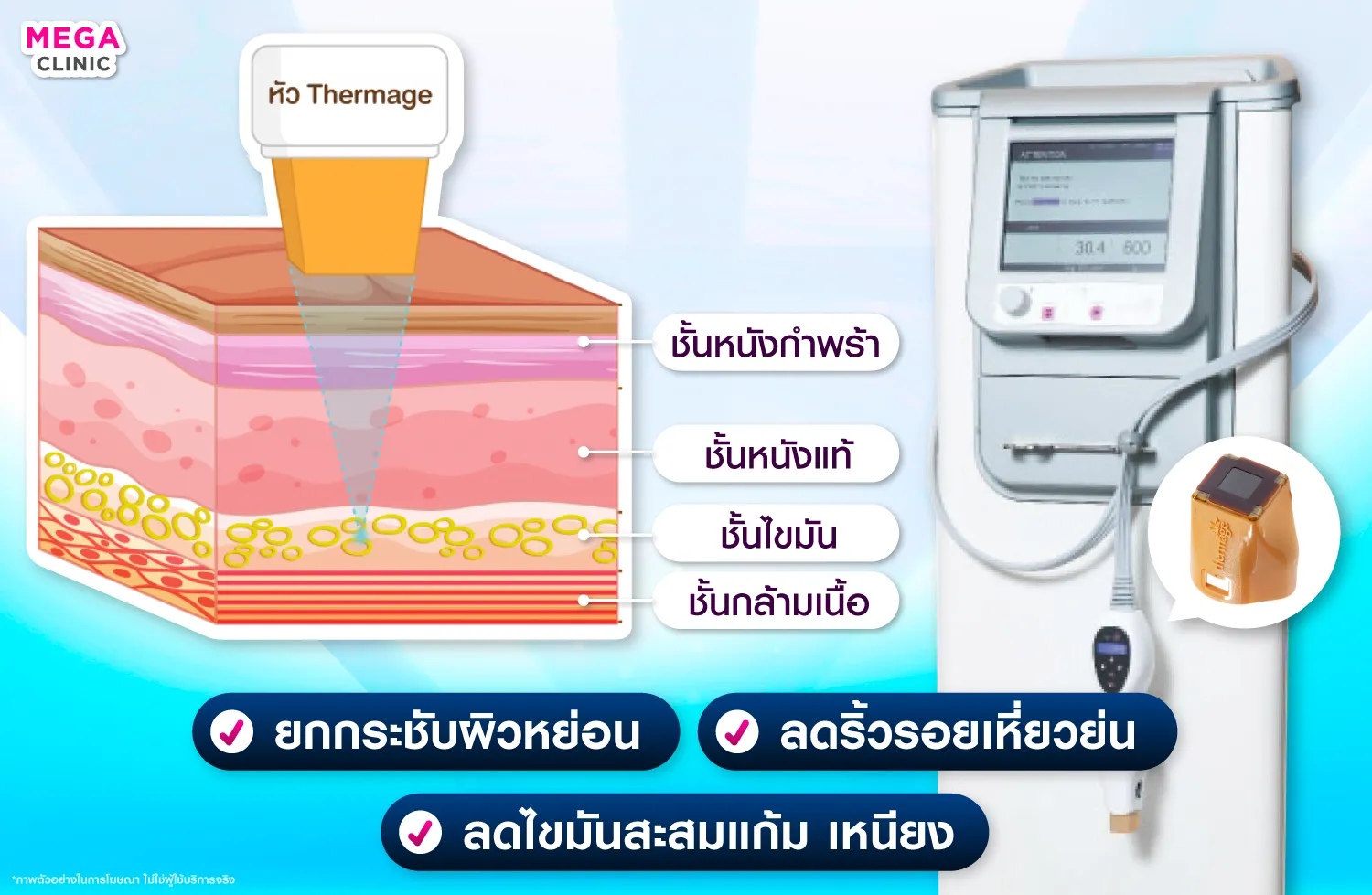 เครื่องยกกระชับ thermage ทำงานอย่างไร ในการช่วยยกกระชับผิวหย่อน ลดไขมันสะสม และ ลดริ้วรอยเหี่ยวย่น