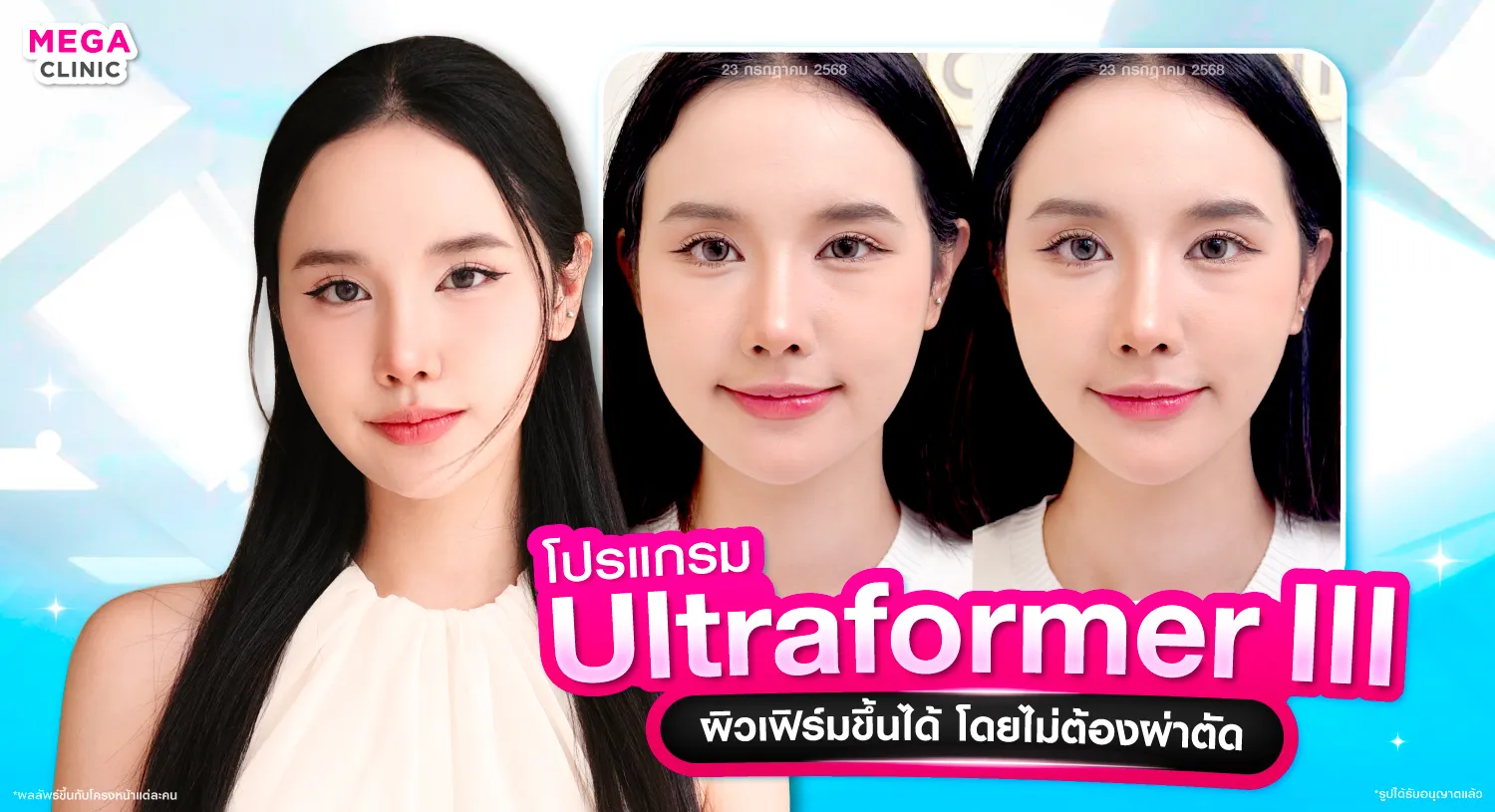 What is Ultraformer III?