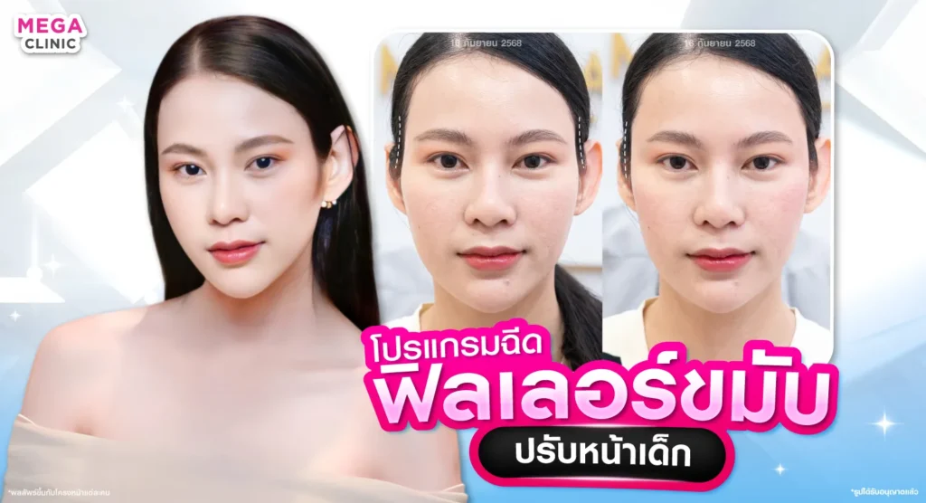 ฟิลเลอร์ขมับคืออะไร ช่วยเติมขมับตอบได้ไหม