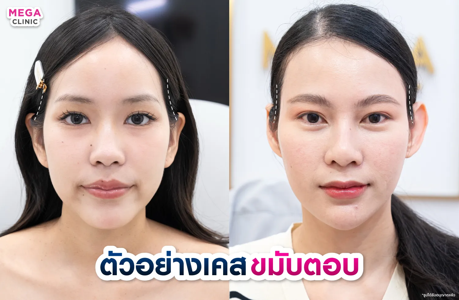 ตัวอย่างคนที่มีขมับตอบ