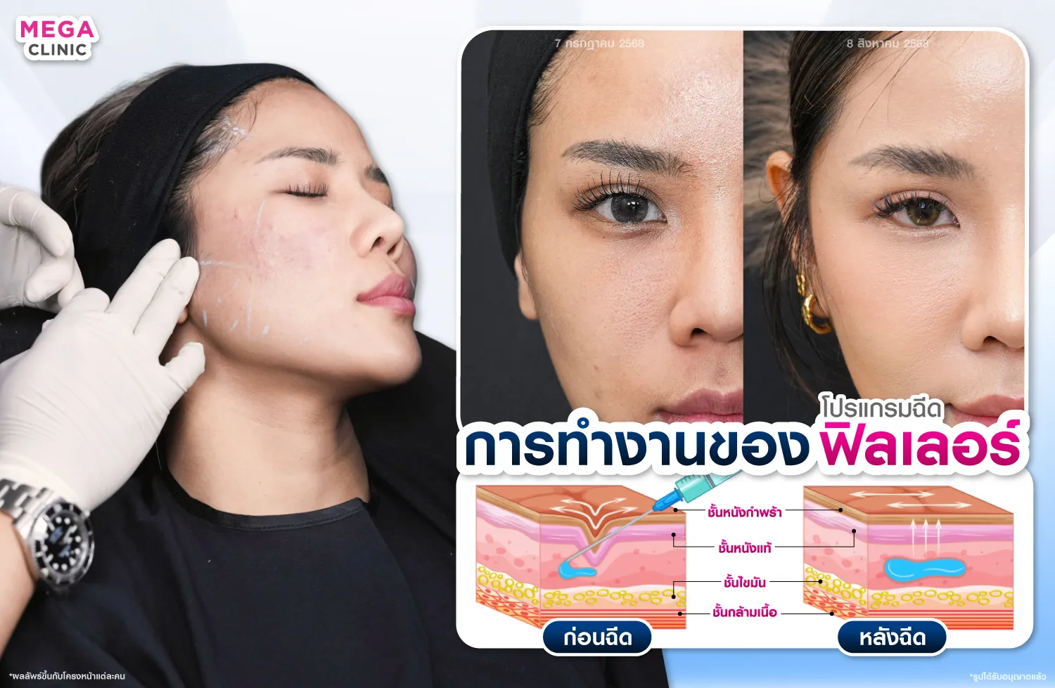 การทำงานของฟิลเลอร์ขมับ