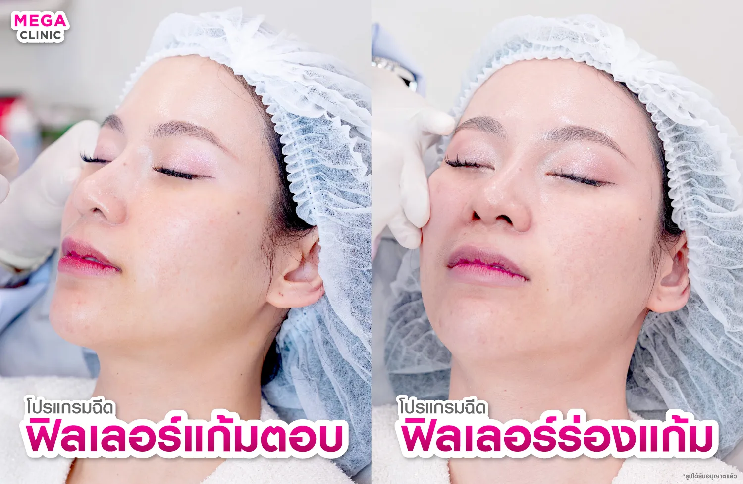 ระหว่างฉีดฟิลเลอร์ร่องแก้ม และฟิลเลอร์แก้มตอบ