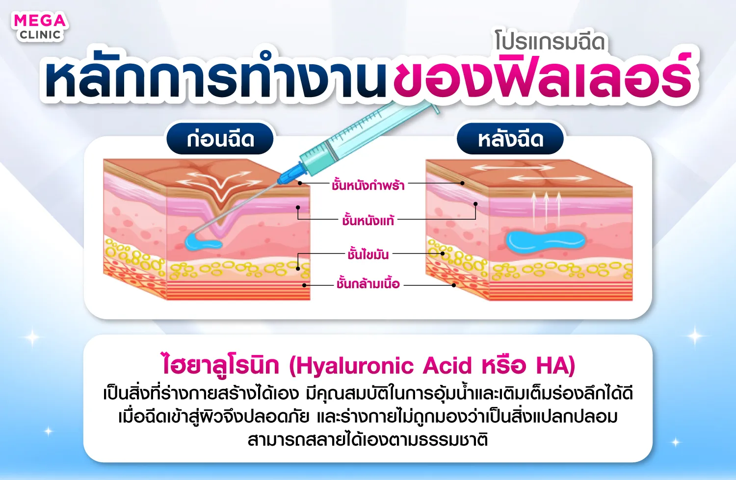 การทำงานของฟิลเลอร์ร่องแก้ม แก้มตอบ ในการเติมเต็มร่อง