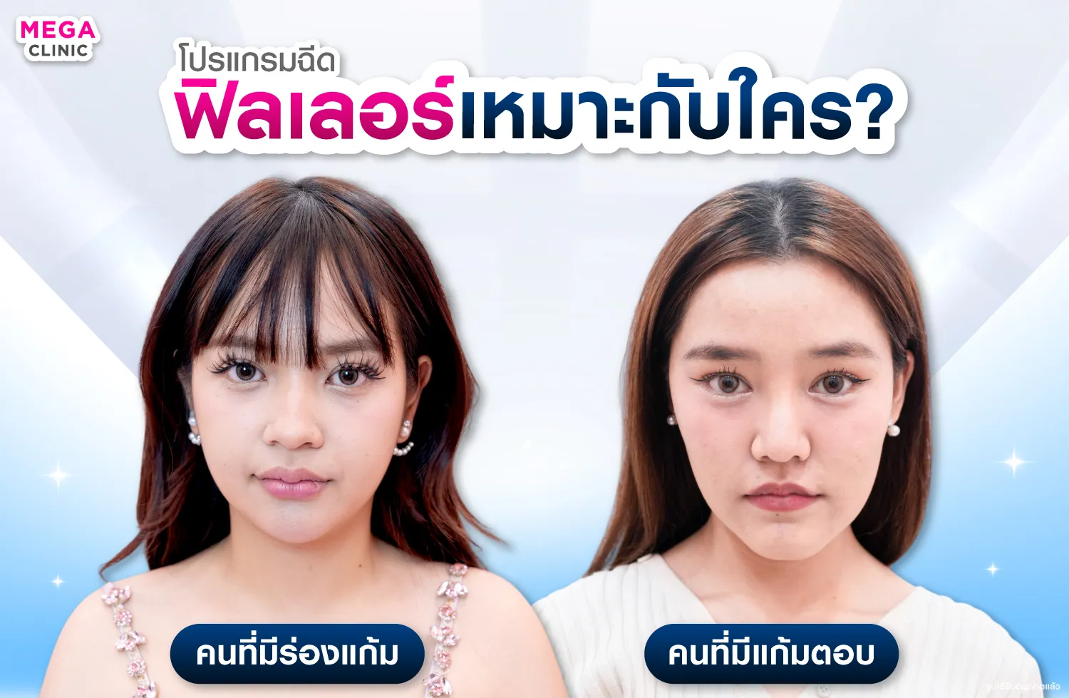 โครงหน้าที่เหมาะกับการฉีดฟิลเลอร์ร่องแก้ม และแก้มตอบ