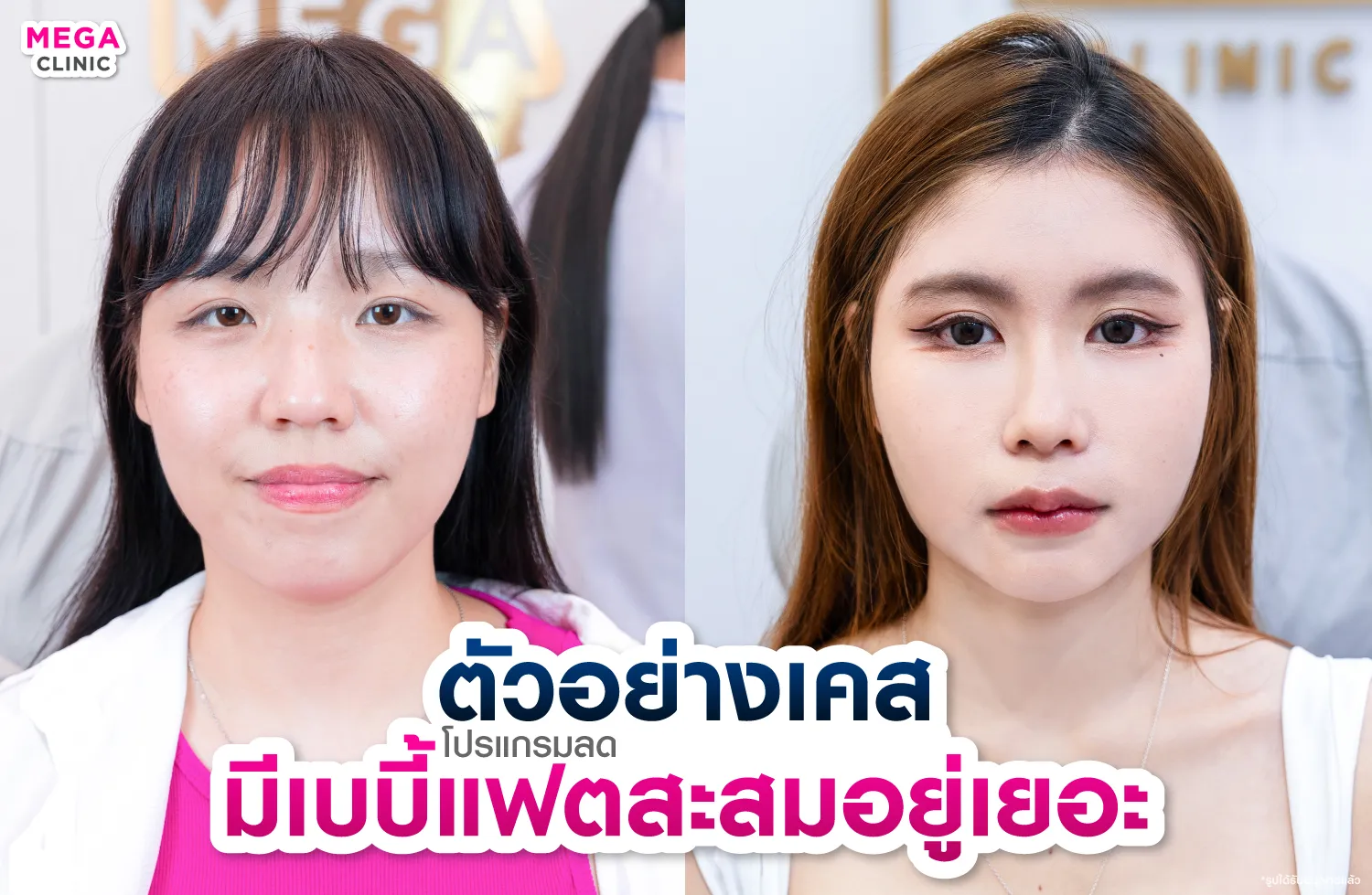 Baby Fat คืออะไร